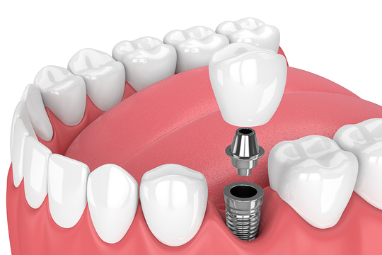 インプラント治療 - 竹内歯科医院（新潟市西蒲区巻）